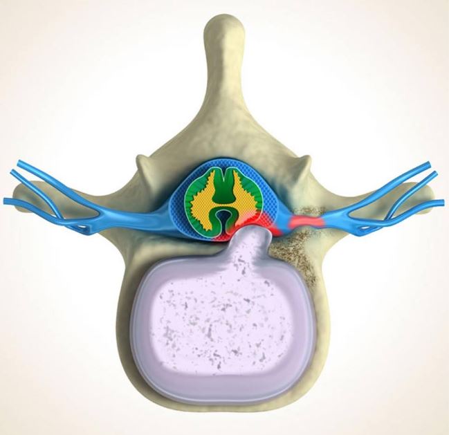 https://www.microspinemd.com/wp-content/uploads/2019/10/Disc-herniation-drawing-with-nerve-compression-nicely.jpg