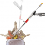 Endoscopic Lumbar decompression