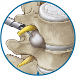 Endsocpic lumbar discectomy