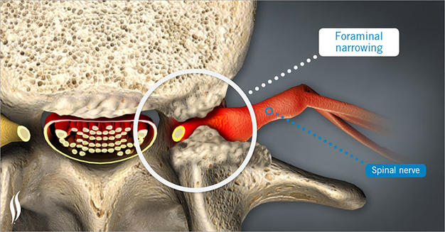 Spinal Canal Stenosis Treatment, Symptoms & Causes