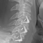 Post C Spine XR