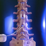 RPC_Spinal_Cord-Stimulator_Overview