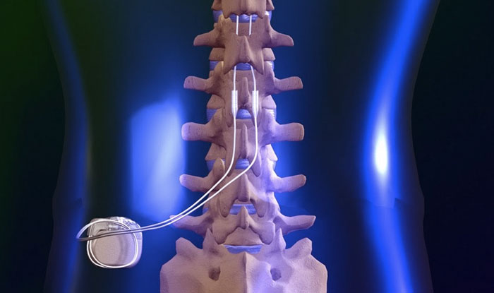 Spinal Cord Stimulator Implant