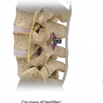 Superion implant - Copy