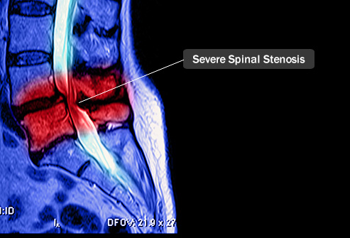 Spinal (Lumbar & Cervical) Stenosis  Scottsdale, AZ Orthopedic Spine  Surgery