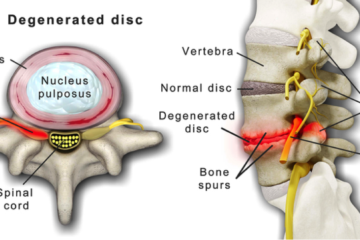 L5 s1 диск остеохондроз. Lumbar vertebrae Plaster. What is a Lumbar Disc?. Lumbar Fixator tomalin Series характеристика пояса. CT L-Spine Protocols.